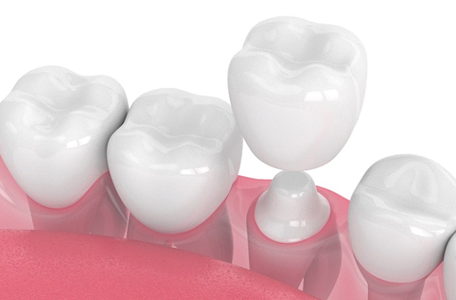 Diagram of how dental crowns in Fitchburg work