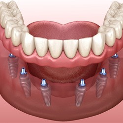 Illustration of implant dentures in Fitchburg