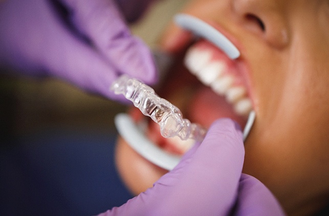 Dentist in Fitchburg placing Invisalign on patient's teeth