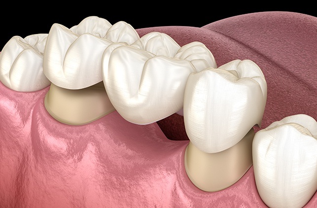 Animated smile during dental bridge placement