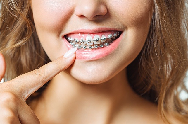 Closeup of smile with self ligating braces