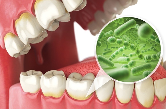 Animated smile with bacteria magnified before antibiotic therapy