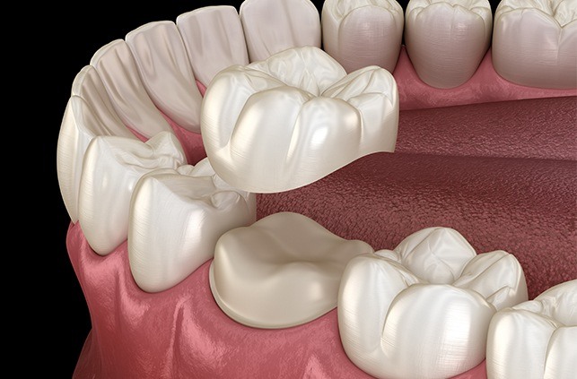 Animated smile during dental crown placement