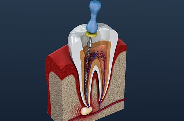 Animated tooth during root canal therapy