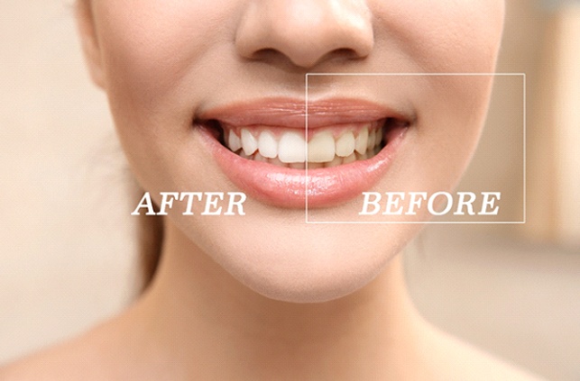 Before and after results of teeth whitening in Fitchburg