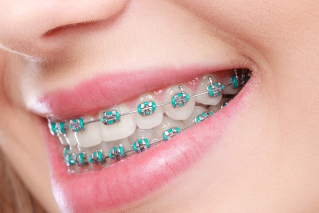 Closeup of traditional braces in Fitchburg