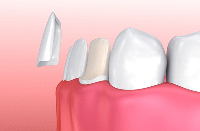 Illustration of veneers in Fitchburg being placed on tooth