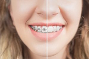 Closeup before and after teeth whitening after braces in Fitchburg