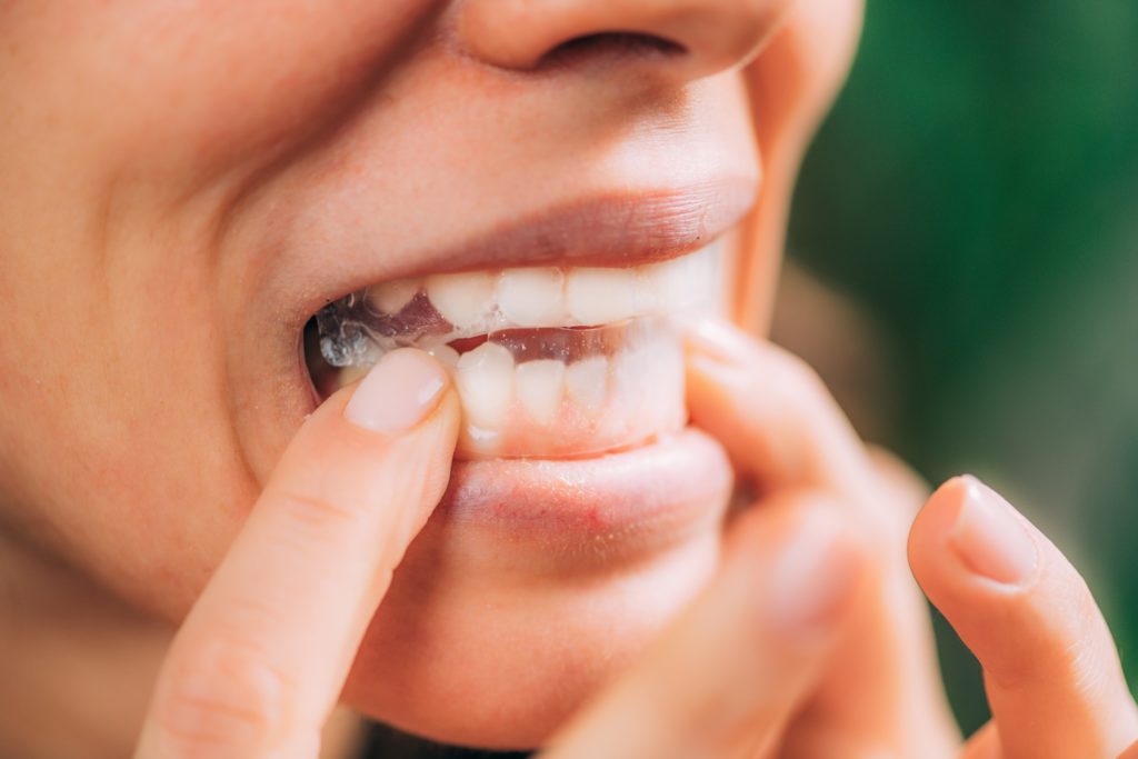 Patient putting store-bought teeth whitening strip on